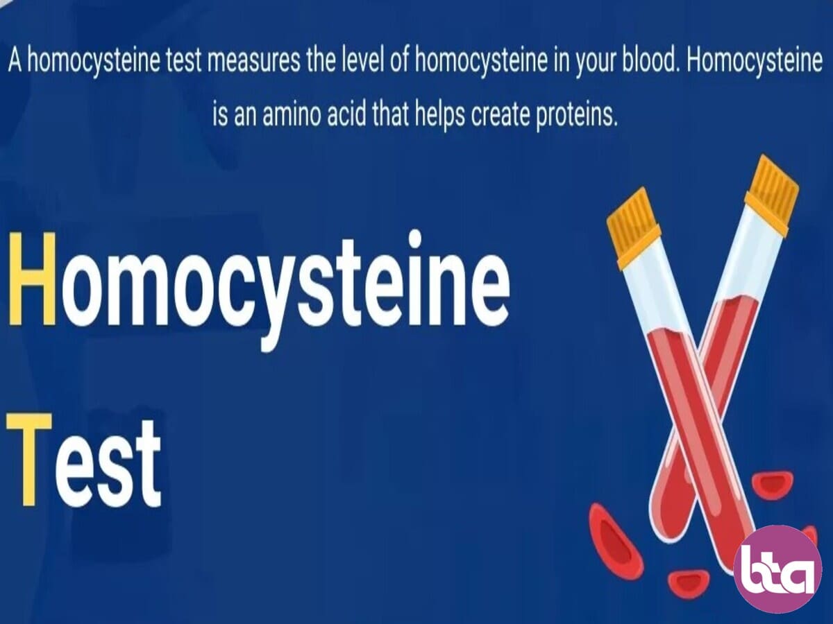 هموسیستئین چیست