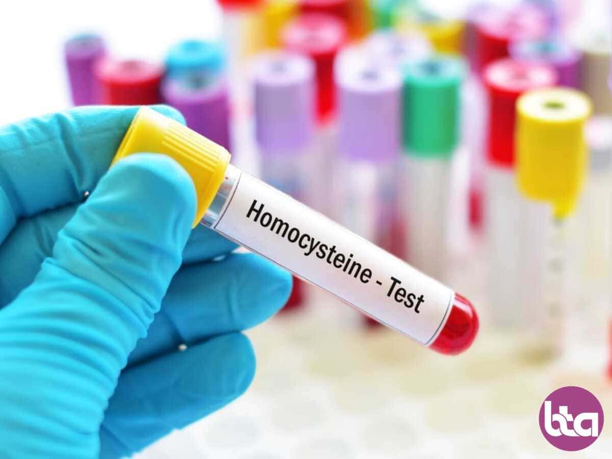 هموسیستئین چیست